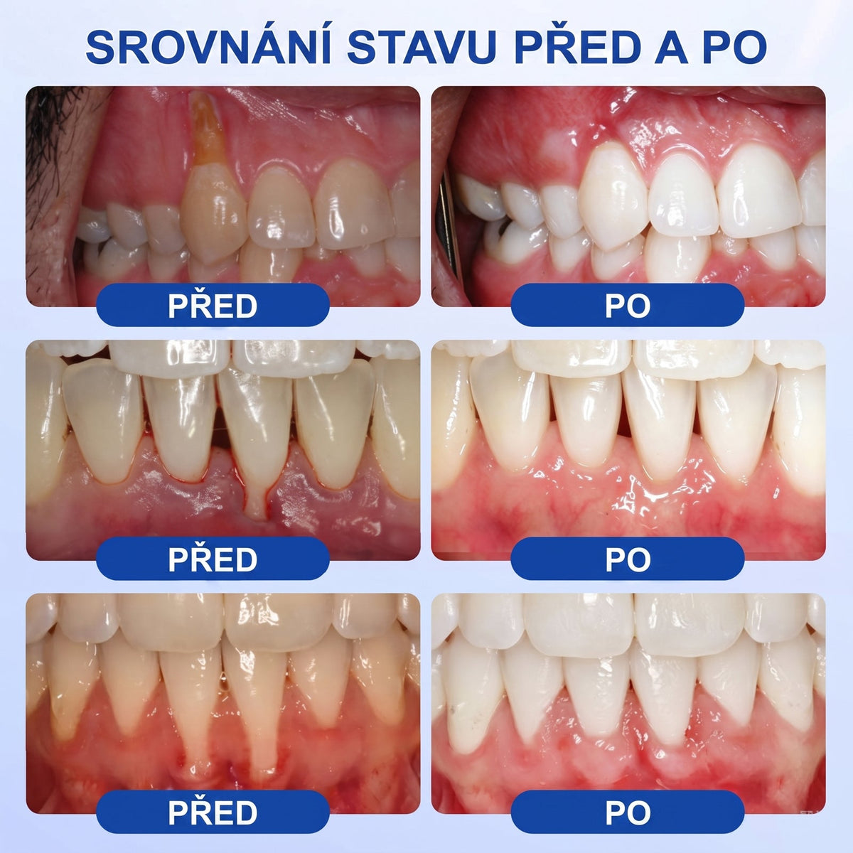 PureShade®👍🦷GumRevive regenerační gel na dásně – pro zdravější dásně a sebevědomější úsměv 👍