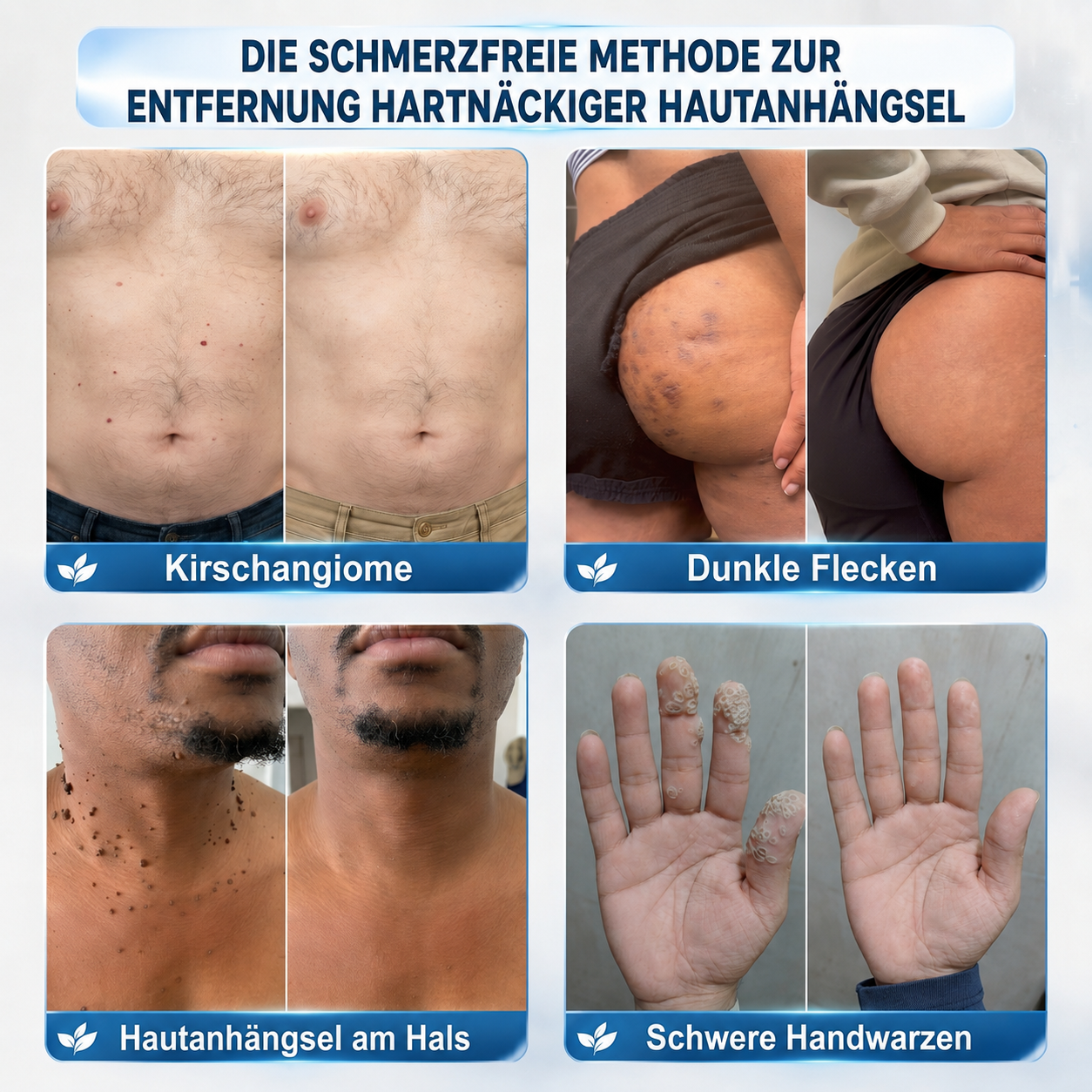 🇩🇪 𝐇𝐈𝐒𝐊𝐈𝐍®👩‍⚕️ 𝟕-𝐓𝐚𝐠𝐞-𝐇𝐚𝐮𝐭𝐚𝐧𝐡ä𝐧𝐠𝐬𝐞𝐥- & 𝐅𝐥𝐞𝐜𝐤𝐞𝐧𝐞𝐧𝐭𝐟𝐞𝐫𝐧𝐞𝐫 – 𝐅𝐨𝐫𝐭𝐬𝐜𝐡𝐫𝐢𝐭𝐭𝐥𝐢𝐜𝐡𝐞𝐫 𝐑𝐨𝐥𝐥-𝐨𝐧-𝐒𝐭𝐢𝐟𝐭 𝐳𝐮𝐫 𝐬𝐜𝐡𝐦𝐞𝐫𝐳𝐟𝐫𝐞𝐢𝐞𝐧 𝐮𝐧𝐝 𝐧𝐚𝐫𝐛𝐞𝐧𝐟𝐫𝐞𝐢𝐞𝐧 𝐄𝐧𝐭𝐟𝐞𝐫𝐧𝐮𝐧𝐠 𝐯𝐨𝐧 𝐇𝐚𝐮𝐭𝐮𝐧𝐫𝐞𝐢𝐧𝐡𝐞𝐢𝐭𝐞𝐧